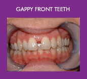 gappy front teeth