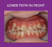 lower teeth in front