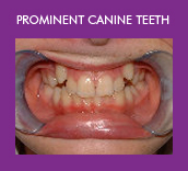 prominent canine teeth