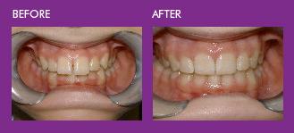 fix protruding upper teeth