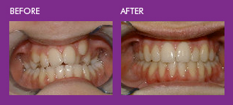 fix overcrowded bottom teeth