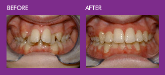 protruding teeth 3